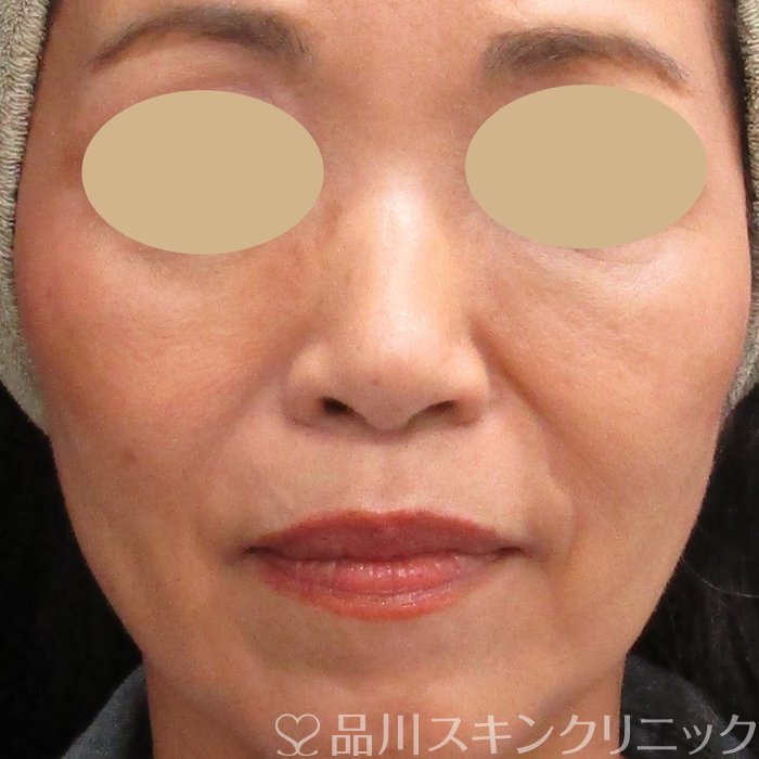 症例NO.74506のBEFORE写真
