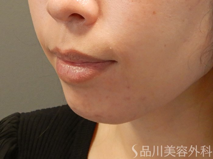 症例NO.69423のBEFORE写真