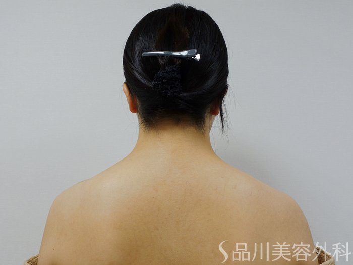 症例NO.73279のBEFORE写真