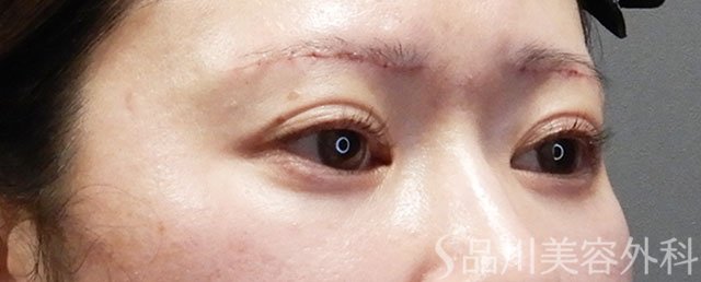 症例NO.73106のAFTER写真