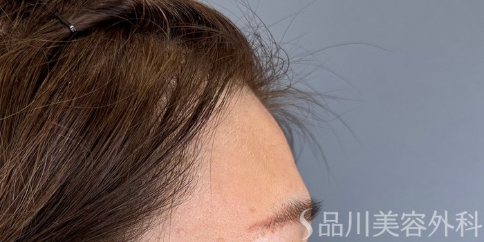 症例NO.73139のBEFORE写真