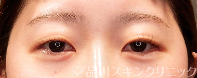症例NO.69366のAFTER写真
