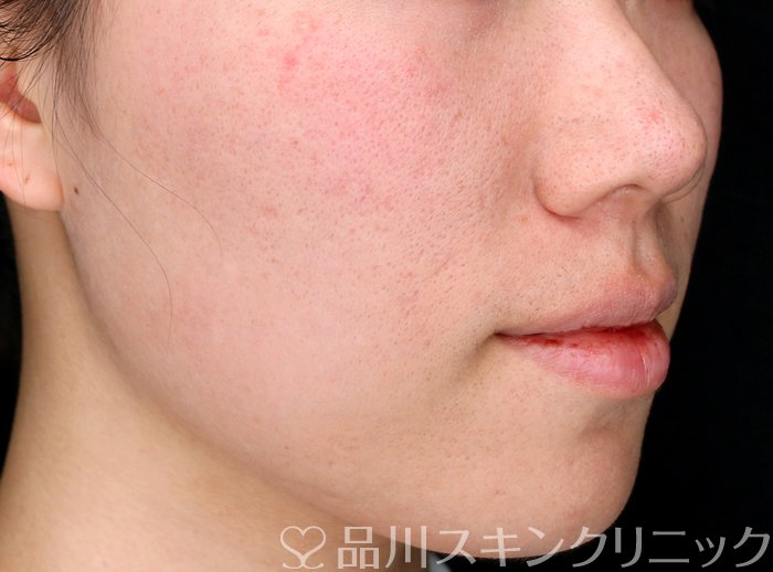 症例NO.69503のBEFORE写真