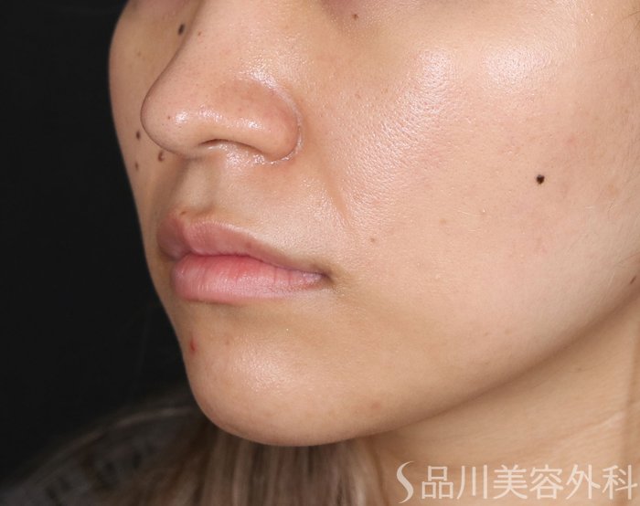 症例NO.70935のBEFORE写真