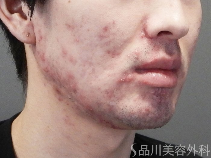 症例NO.73146のBEFORE写真