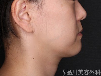 症例NO.71274のBEFORE写真