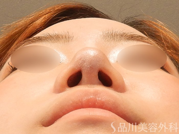 症例NO.70397のAFTER写真