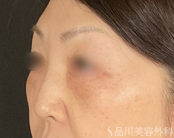症例NO.74547のBEFORE写真