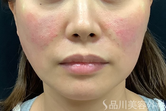 症例NO.71581のAFTER写真