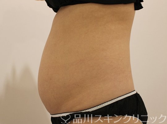 症例NO.64052のBEFORE写真
