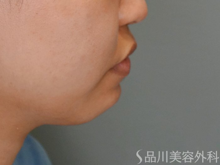 症例NO.69459のBEFORE写真