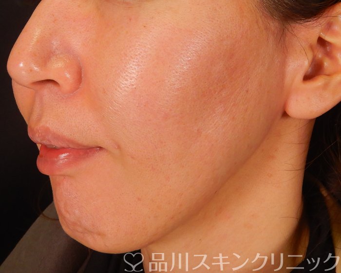 症例NO.64227のAFTER写真