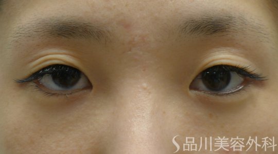 症例NO.62672のBEFORE写真