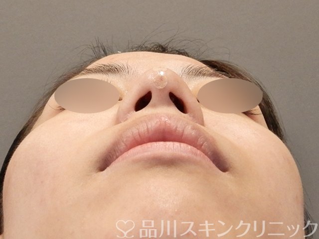 症例NO.75040のAFTER写真
