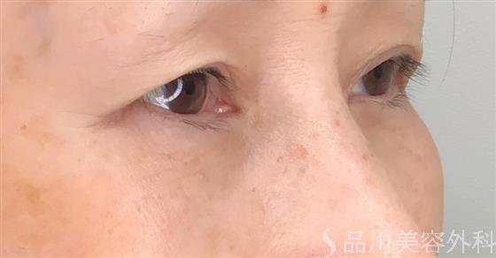 症例NO.53993のAFTER写真
