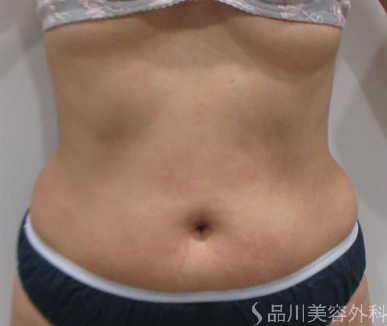 症例NO.22506のAFTER写真