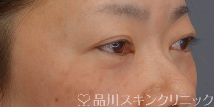 症例NO.73114のAFTER写真