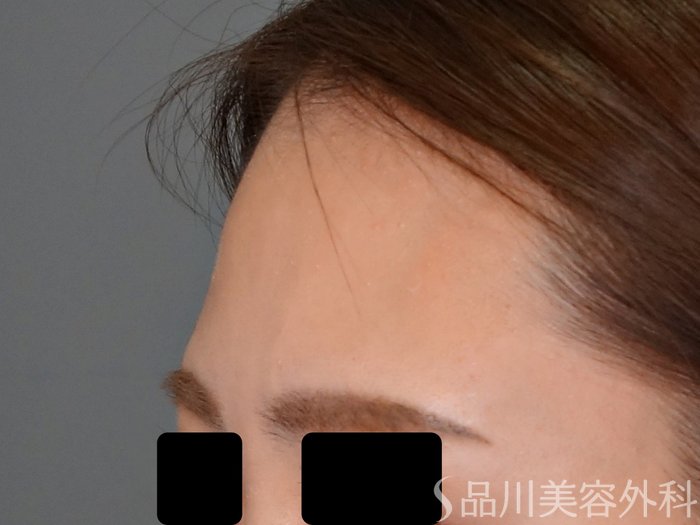 症例NO.68258のBEFORE写真