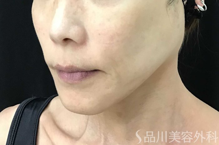 症例NO.71108のAFTER写真