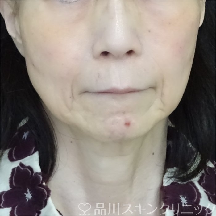 症例NO.70611のAFTER写真