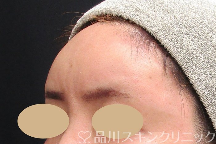 症例NO.74720のAFTER写真