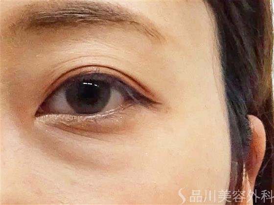 症例NO.57535のAFTER写真