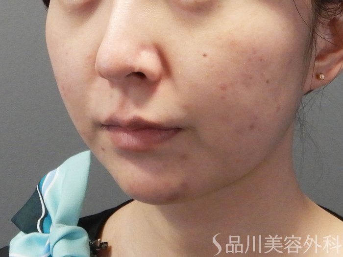 症例NO.72591のBEFORE写真