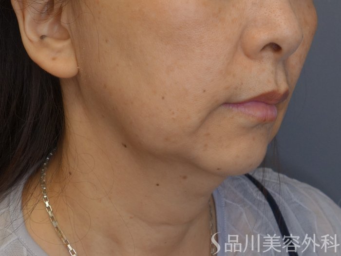 症例NO.70472のBEFORE写真