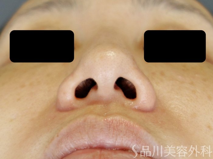 症例NO.71511のBEFORE写真