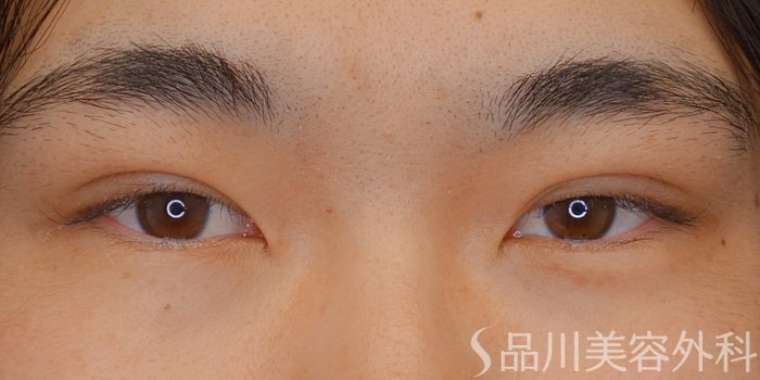 症例NO.70328のAFTER写真