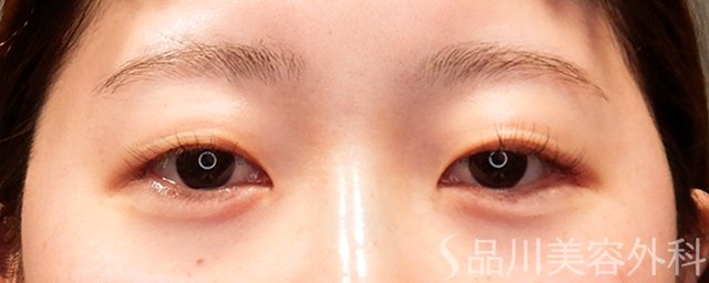 症例NO.69366のAFTER写真