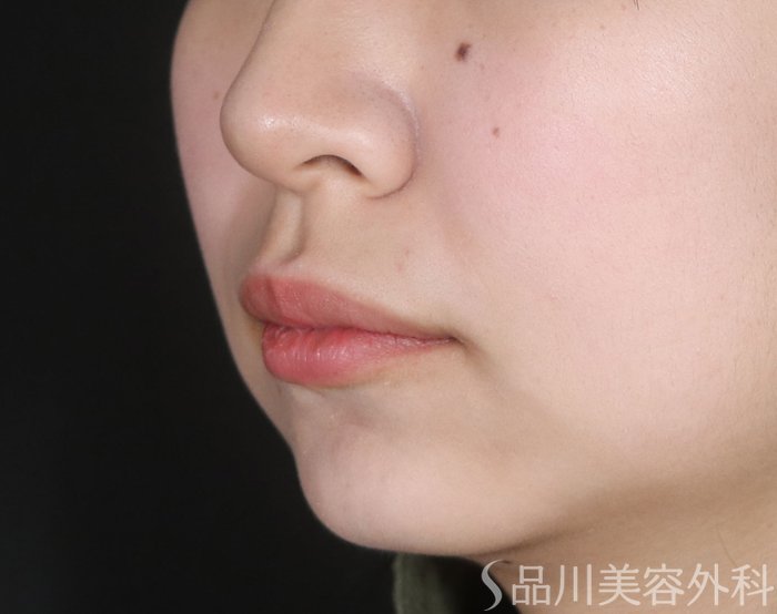 症例NO.72863のBEFORE写真