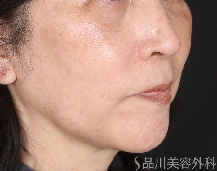 症例NO.72914のAFTER写真