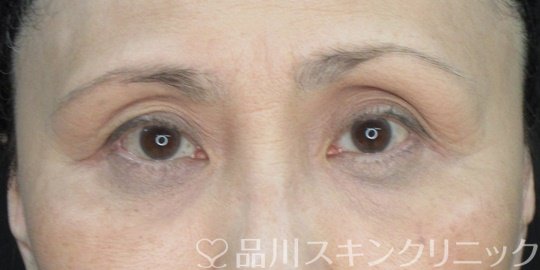 症例NO.73325のAFTER写真