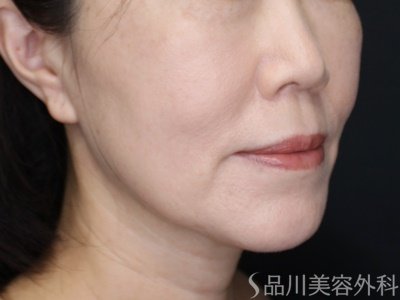 症例NO.72315のAFTER写真