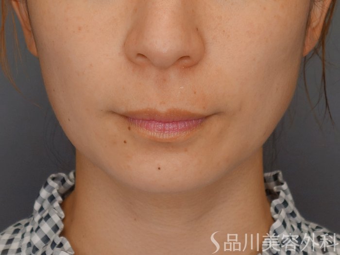 症例NO.71288のBEFORE写真