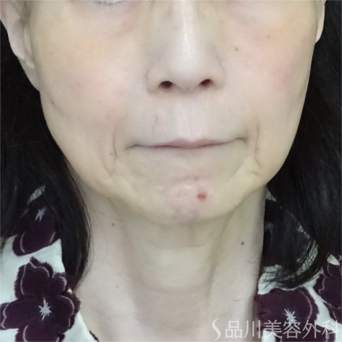 症例NO.70611のAFTER写真