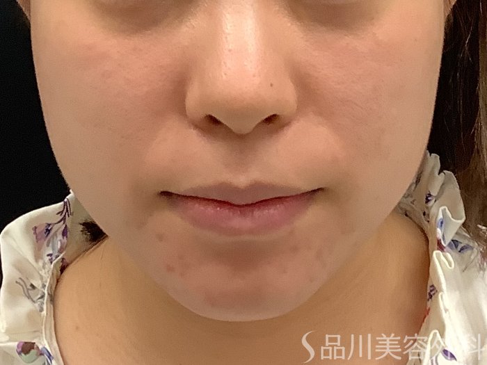 症例NO.71000のBEFORE写真