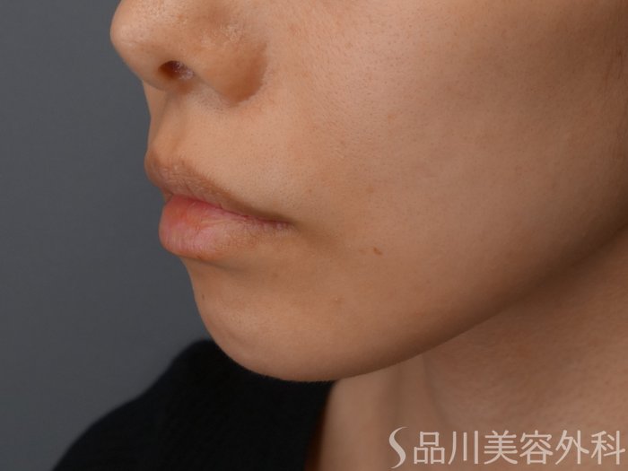 症例NO.69549のBEFORE写真