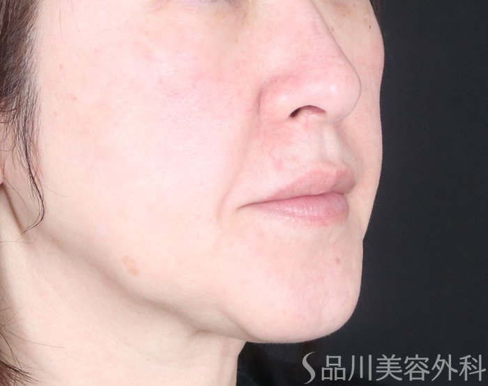 症例NO.73170のBEFORE写真