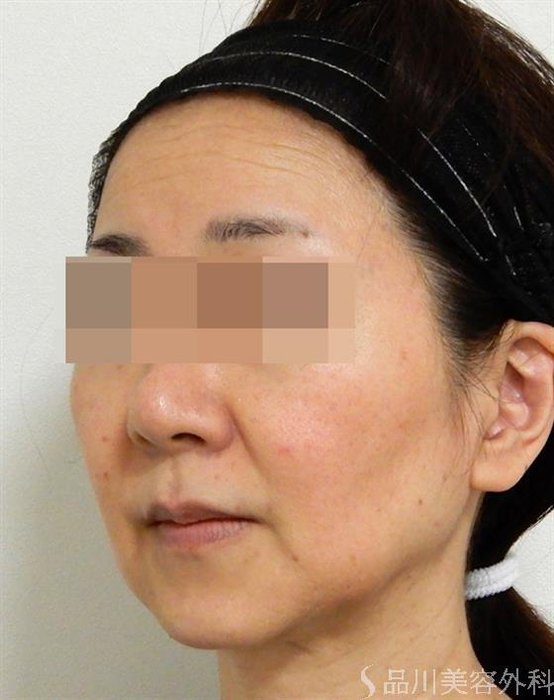 症例NO.38737のBEFORE写真
