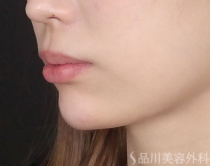 症例NO.65393のAFTER写真