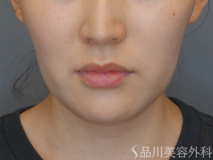 症例NO.70891のBEFORE写真