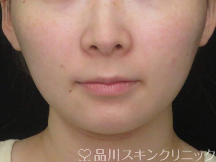 症例NO.70391のBEFORE写真