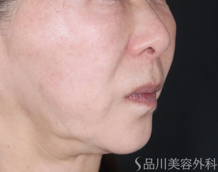 症例NO.72945のBEFORE写真