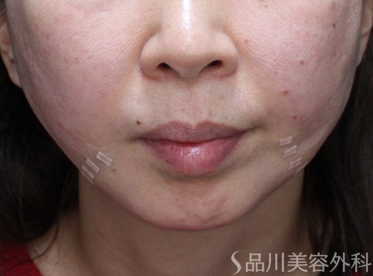 症例NO.73442のAFTER写真