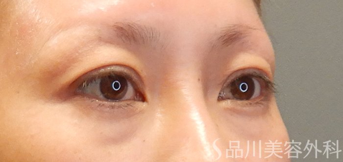 症例NO.71405のBEFORE写真