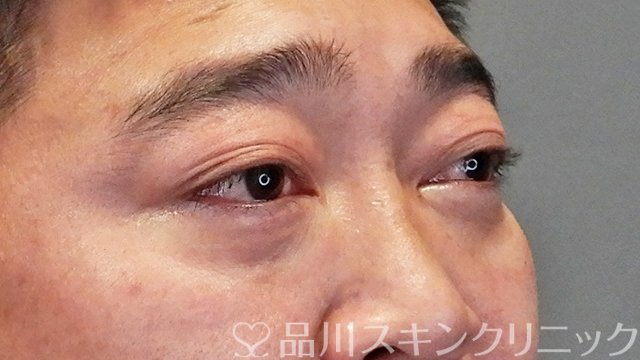 症例NO.64614のAFTER写真