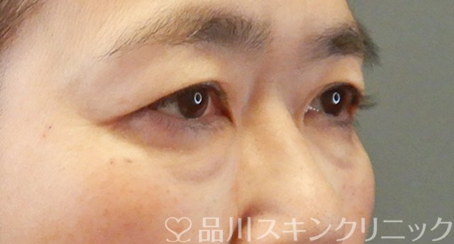 症例NO.67336のAFTER写真