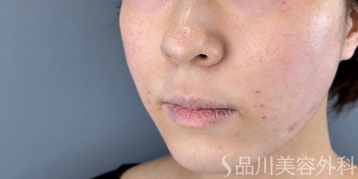 症例NO.71960のAFTER写真